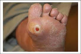 CC: Diabetic foot infection in left foot