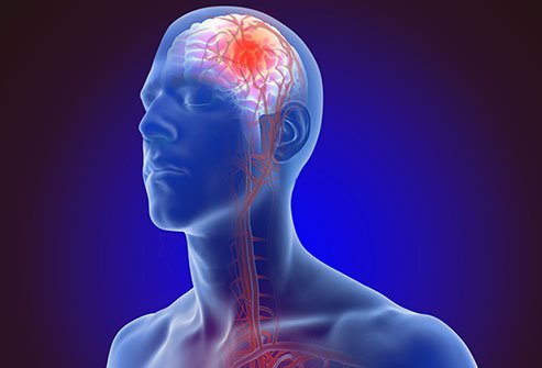 What causes a stroke and what are the symptoms