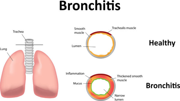 A nursing concept map for a child with bronchiolitis
